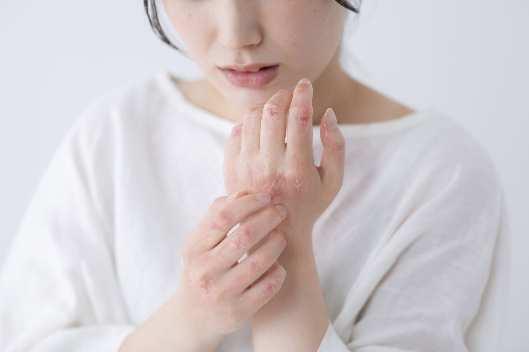 アトピー性皮膚炎・乾癬